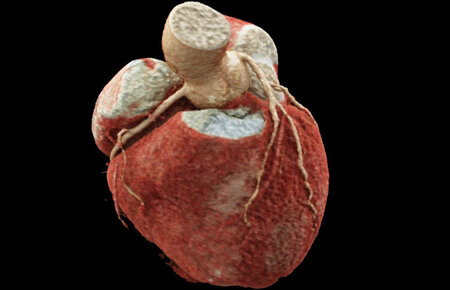 Die VRT (Volume-Rendering-Technik) ermöglicht eine dreidimensionale Darstellung des Herzens in der CT-Untersuchung.
